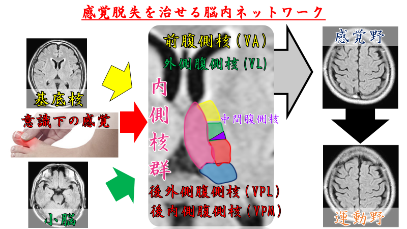 視床brs 感覚脱失 治療編 脳科学リハビリテーション協会 視床brs 感覚脱失 治療編 脳科学リハビリテーション協会