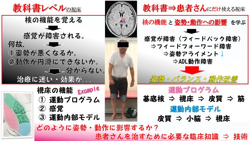 視床brs 感覚脱失 治療編 脳科学リハビリテーション協会